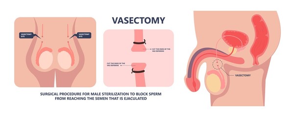 in vitro fertilization IVF semen test sample sperm count type Male biopsy fertility collect Low Poor Zero head anatomy midpiece tail birth control blocked defect abnormal ejaculate vas Non dry
