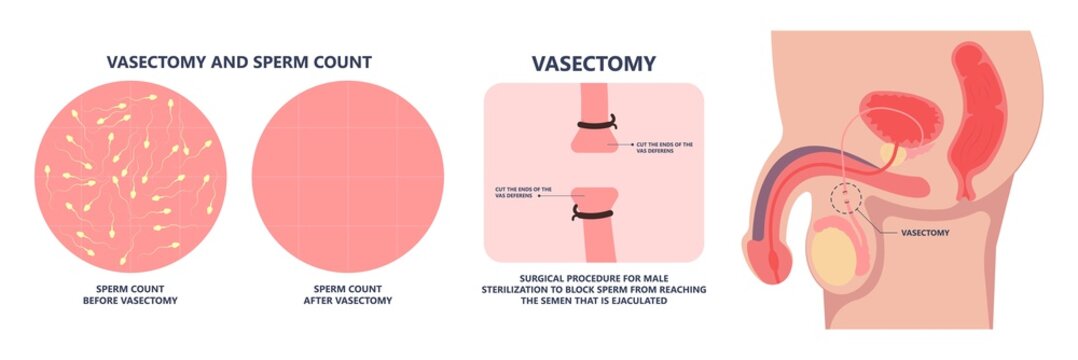 in vitro fertilization IVF semen test sample sperm count type Male biopsy fertility collect Low Poor Zero head anatomy midpiece tail birth control blocked defect abnormal ejaculate vas Non dry