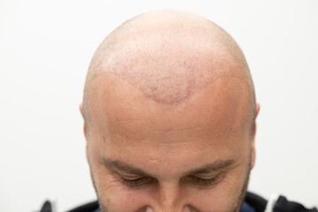 man after hair implant therapy