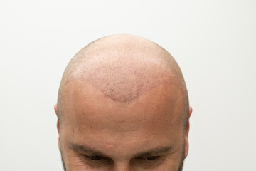 man after hair implant therapy