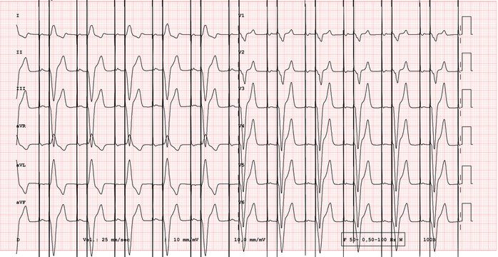 ECG example of a dual chamber pacemaker 12-lead rhythm with pacing peak