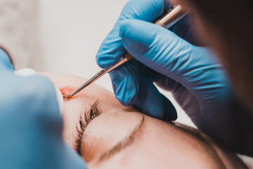 Milium on the face, removal of milia with a syringe in cosmetology.
