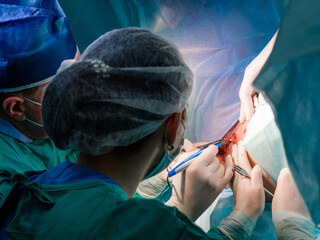 During proctological surgery on the anus, the surgeon holds an electric coagulator. Close-up -...
