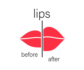 Lips before and after botox injection. Symbol. Vector illustration.