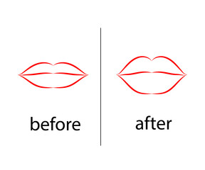 Lips before and after botox injection. Symbol. Vector illustration.