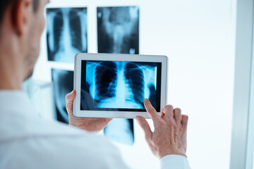 Doctor examining x-ray of chest and ribs on digital tablet. - 420413326