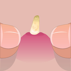 Squeezing out the pimple with your fingers. Vector illustration