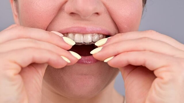 Close-up portrait of a woman putting on a transparent plastic retainer. A girl corrects a bite with the help of an orthodontic device