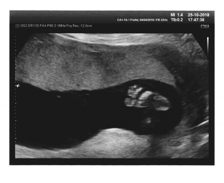 Ultrasound at 17 weeks
