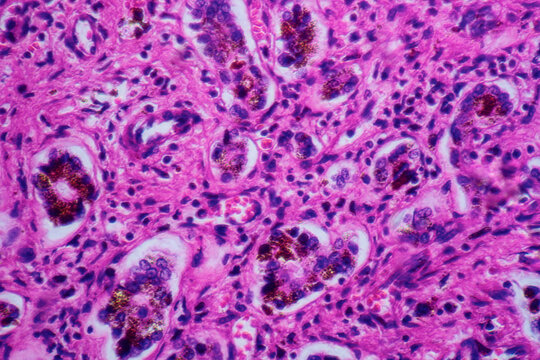 ill human liver cells of biliary cirrhosis