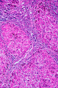ill human liver cells of biliary cirrhosis