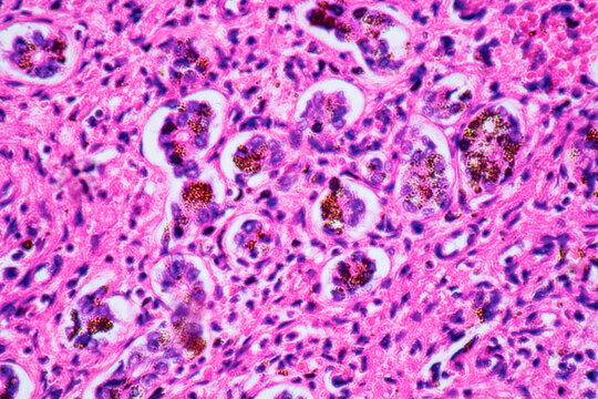 ill human liver cells of biliary cirrhosis