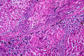 ill human liver cells of biliary cirrhosis