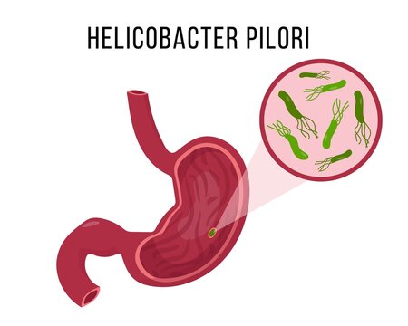 Human stomach infected Helicobacter Pilori.