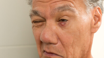 Man with a huge stye on his eyelid 