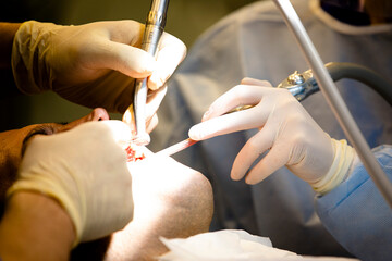 Close up dentist teeth operation 