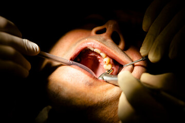 Close up dentist teeth operation 