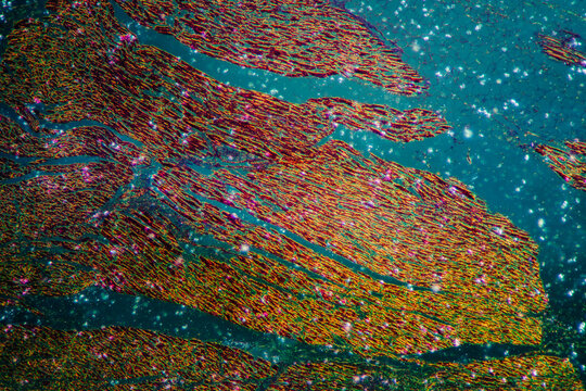 Rheumatic endocarditis human cells micrograph