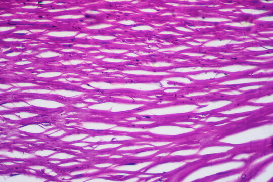 micrograph of human coronary artery atherosclerosis cells
