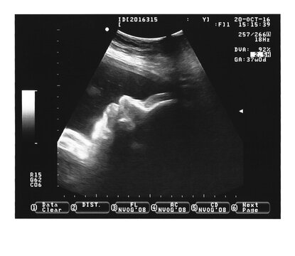 Ultrasound portrait at 37 weeks