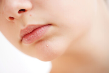 Obraz premium Teenage acne on the chin. Close up face with pimple. Teen problem. High quality photo.