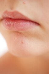 Teenage acne on the chin. Close up face with pimple. Teen problem. High quality photo.