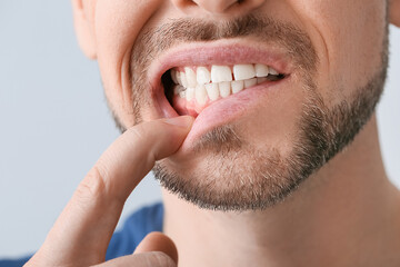 Man suffering from tooth ache, closeup - obrazy, fototapety, plakaty