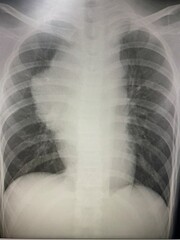 Film chest X-ray show mass at anterior  mediastinum  rule out lung tumor for medical and technology...