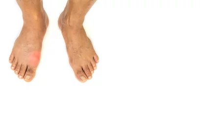 Foto op Aluminium Foot disease Rheumatism and gout. Red leg swelling. Pain in the foot © suththirat