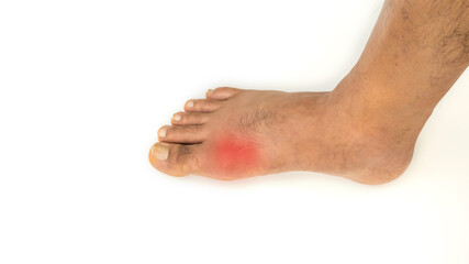 Foot disease Rheumatism and gout. Red leg swelling. Pain in the foot