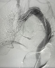 Angiogram of  Thoracic endovascular aortic repair (TEVAR).	

