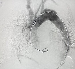 Angiogram of aorta shown aortic dissection type B at descending aorta during Thoracic endovascular aortic repair (TEVAR). - obrazy, fototapety, plakaty