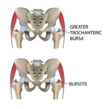 Hip bursitis, vector medical illustration