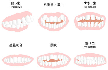 歯列矯正治療の対象になる代表的な症例セット　塗りのみ線なし
