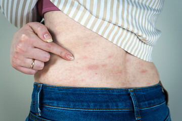Women with symptoms of itchy urticaria or allergic reaction on the skin. Red rash on the females...