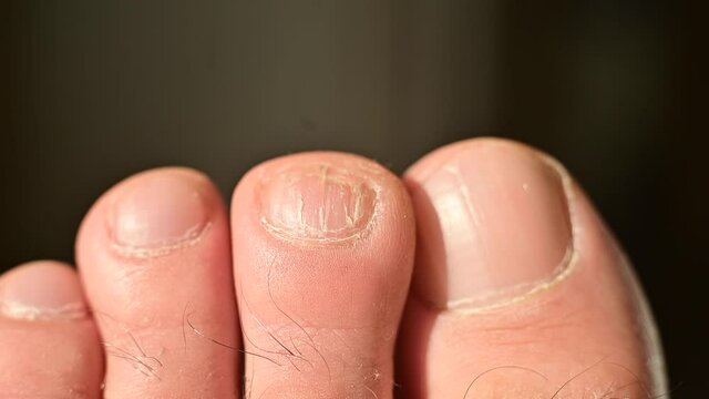 Close-up of male toes with a cracked nail