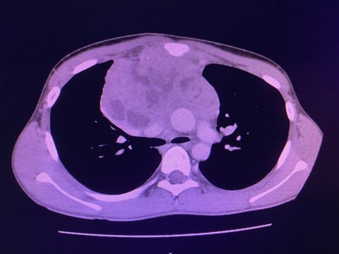 CT scan show heterogeneous mass at interior mediastinum , the mass slightly invade proximal lower part of svc for medical and technology concepts 