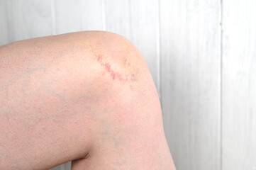 Fototapeta premium Knee injury after impact. Bruising on the knee joint.