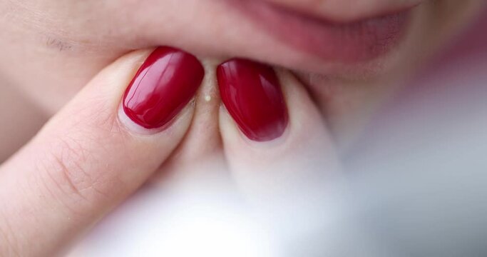 Young woman squeezing out pimple with her hands closeup 4k movie
