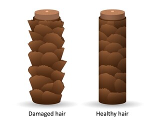 Damaged and healthy hair under microscope. Brown keratinous scaly structure with dermatitis and alopecia areata risk head lice and vector fungus.