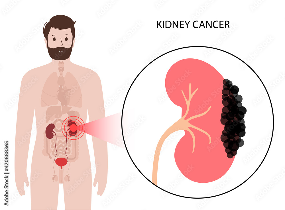 Poster Kidney disease concept