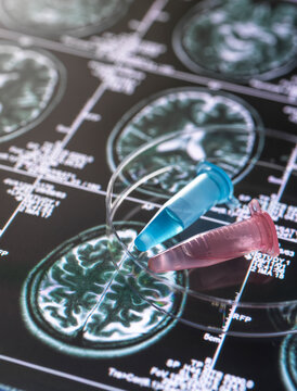 Clinical samples from research project contained in vials with brain scan images, research into Alzheimers and dementia medical conditions.
