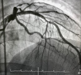 Coronary angiogram shown left anterior descending artery (LAD) stenosis during cardiac catheterization.