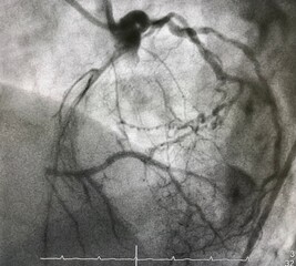 coronary angiogram showed chronic total occlusion (CTO) of left anterior descending artery (LAD) with collateral from right coronary artery (RCA).