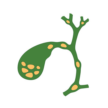 Variants Of The Location Of Stones In The Gallbladder And Bile Ducts. Schematic Drawing For Cholelithiasis, Gallstone Disease. Isolated Vector Illustration On White Background