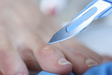 Doctor holding scalpel over corn on womans leg closeup