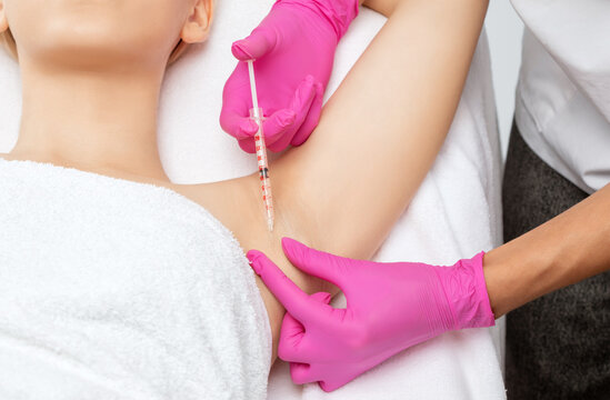 The doctor makes injections of botulinum toxin in the underarm area against hyperhidrosis. Women's cosmetology concept.