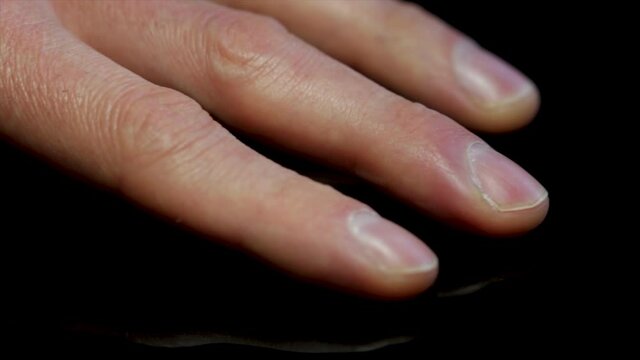 Hand close up male fingers with inflammation from hangnail infection. Close up male hand on black background.