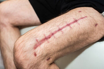 postoperative suture on the male leg. a large scar on the man's thigh. red stitches. recovery and wound healing