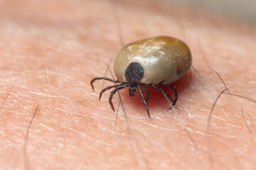 A tick drunk on blood crawls on human skin